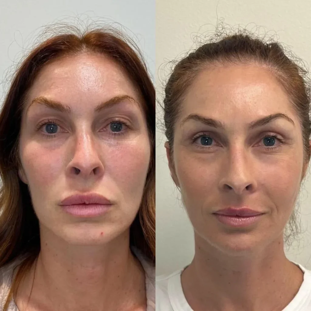 Best Non-Surgical Facelift for Jowls: What the Experts Say